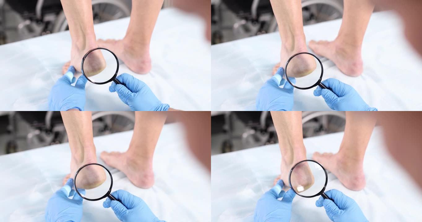 皮肤科医生通过放大镜对腿部皮肤进行体格检查