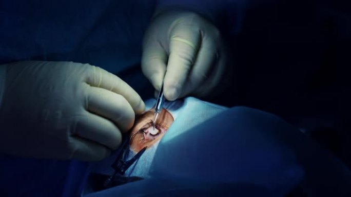 眼科手术。手术期间用手术器械擦拭患者眼睛的眼科专家的手。手术室眼科治疗过程。特写。
