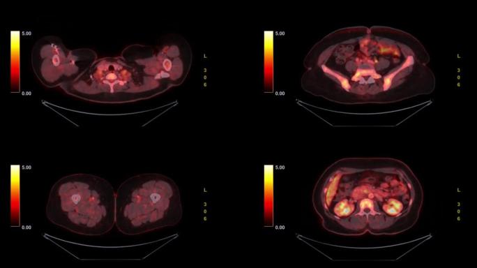 全身PET ct扫描。