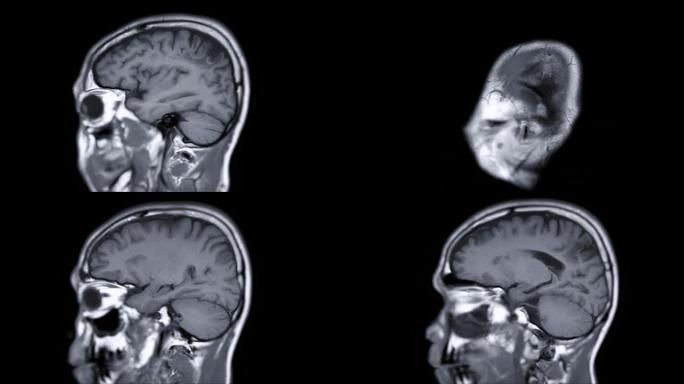 脑矢状位T1W平面的MRI，脑的磁共振成像。