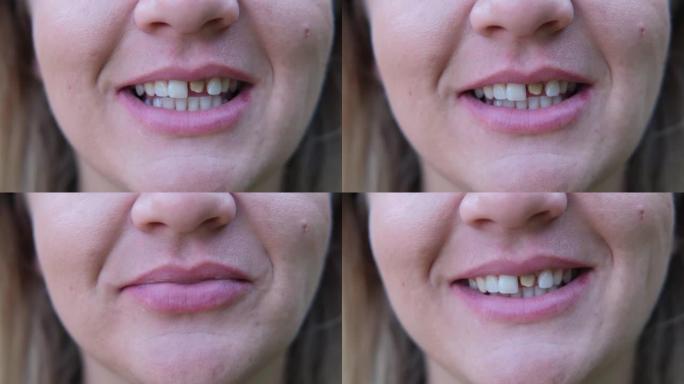 女人带着坏牙齿的微笑。治疗前的牙齿。特写。