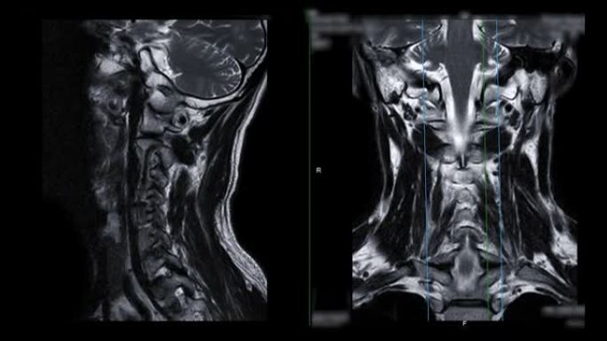 颈椎MRI比较矢状位T2W和冠状位T2W可诊断脊髓压迫。