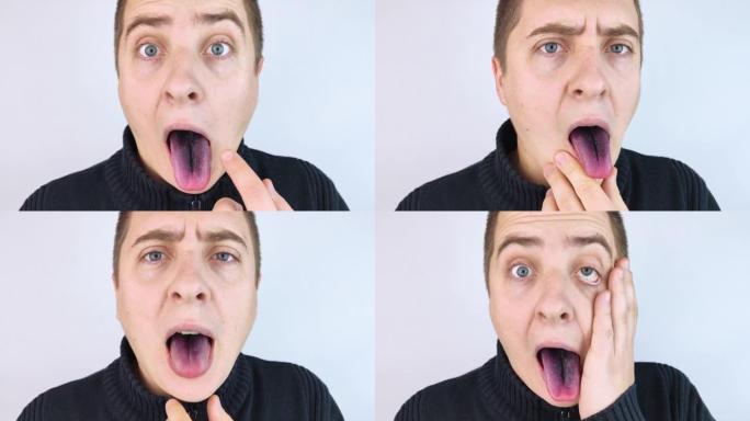 一个男人黑色舌头的特写。绒毛舌的临床表现。口腔细菌感染。服用强抗生素的后果。真菌感染
