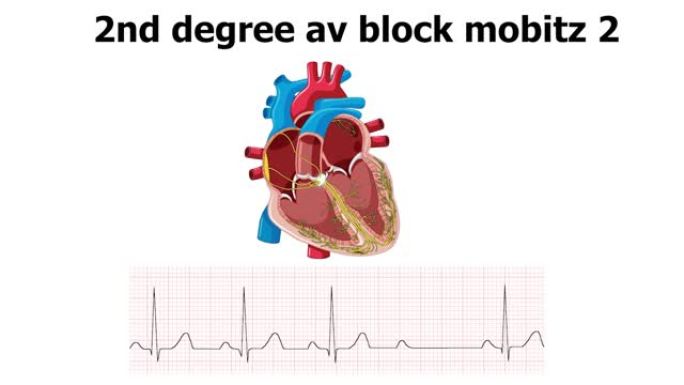 心电图显示心律不齐2d度室阻mobitz2伴心脏动画