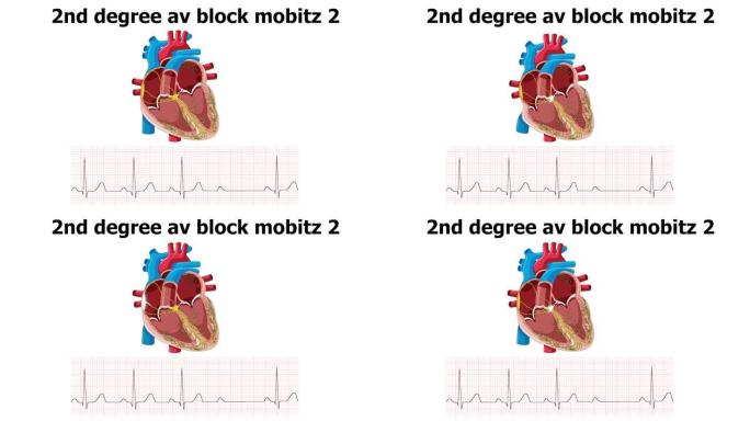 心电图显示心律不齐2d度室阻mobitz2伴心脏动画