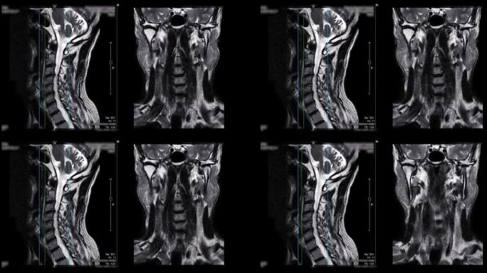颈椎MRI比较矢状位T2W和冠状位T2W可诊断脊髓压迫。