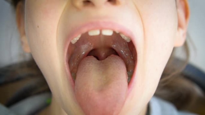 张开嘴巴，伸出舌头，看到小舌和小女孩的软腭，小儿牙科