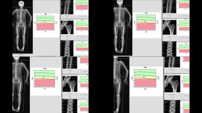 特殊检查结果腕部，髋部和脊柱骨密度。在全分辨率下观看时，图像过于模糊和伪影。