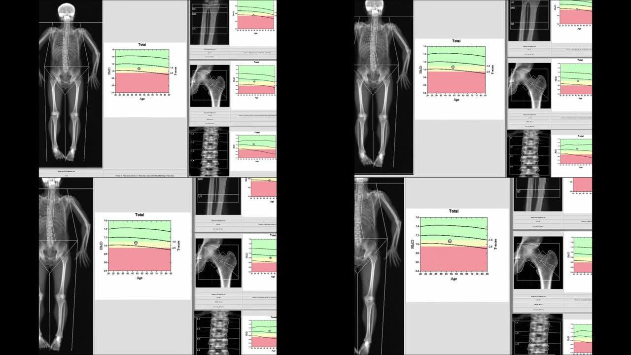 特殊检查结果腕部，髋部和脊柱骨密度。在全分辨率下观看时，图像过于模糊和伪影。