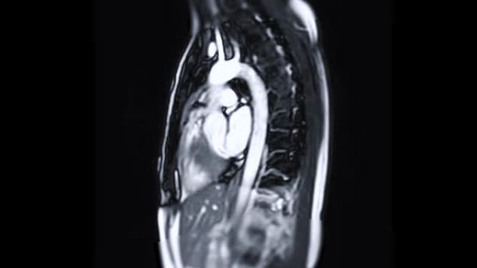 MRI心脏或心脏MRI (磁共振成像)。