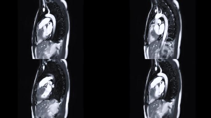 MRI心脏或心脏MRI (磁共振成像)。