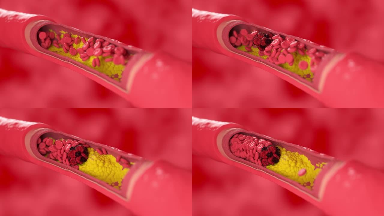 血凝块阻塞受胆固醇斑块影响的血管横截面视图。