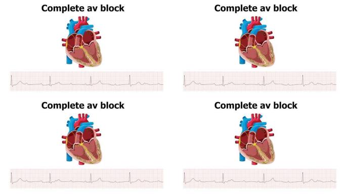 心电图显示心律失常完全房室传导阻滞伴心脏动画