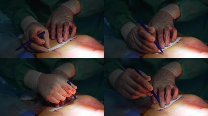 医生在手术期间在病人的腹部划清界限。吸脂手术期间，外科医生的手戴着手套，腹部有血。特写。
