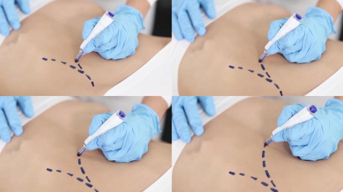 整形外科医生在患者腹部特写4k电影慢动作上绘制术前标记