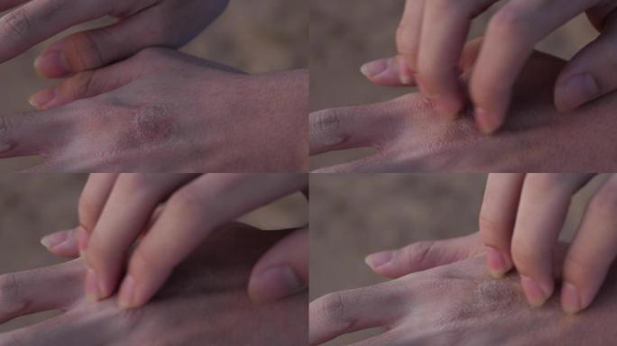 手抓皮肤与真菌病，