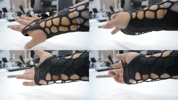 黑色矫形塑料假体印在手头的粉末3D打印机上。矫形石膏在手臂特写上。多喷射融合MJF 3D打印技术新的