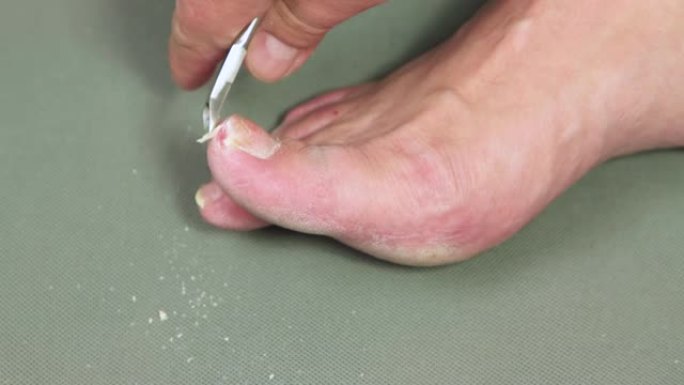 一个男人的手用钳子割掉了大脚趾的指甲。