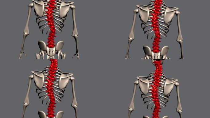 脊柱侧弯，脊柱弯曲，驼峰，骨骼