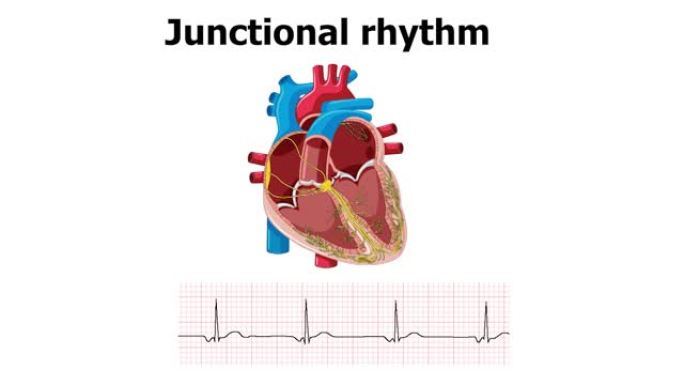 心电图显示心律失常交界节律伴心脏动画