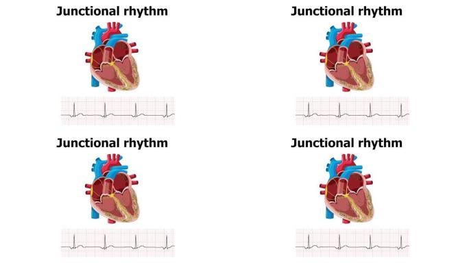 心电图显示心律失常交界节律伴心脏动画