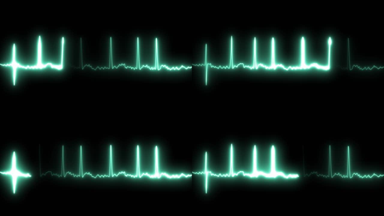 心房颤动患者的心电图。