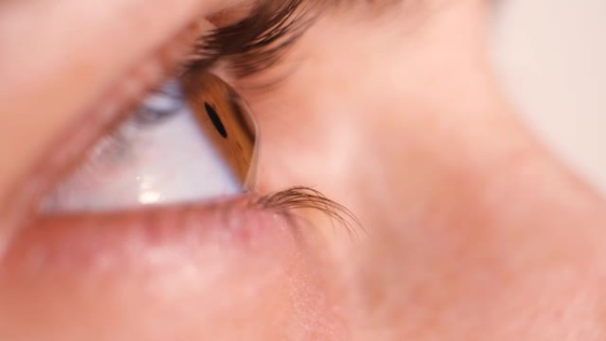 圆锥角膜患者的眼睛