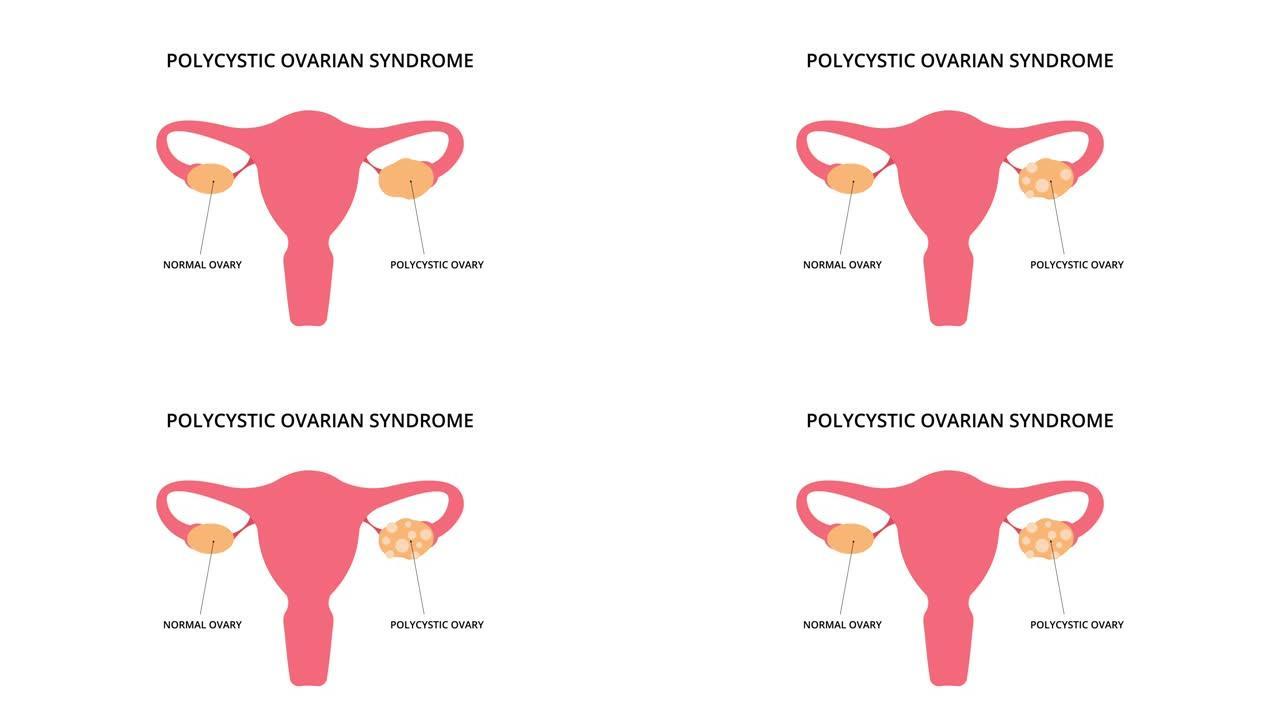 多囊卵巢综合征2D动画