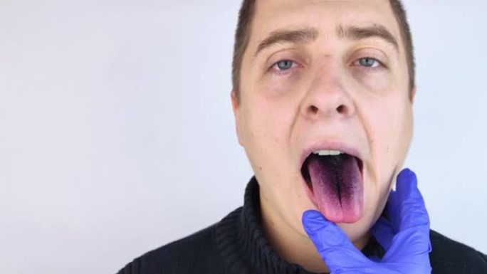 一个男人黑色舌头的特写。绒毛舌的临床表现。口腔细菌感染。服用强抗生素的后果。真菌感染