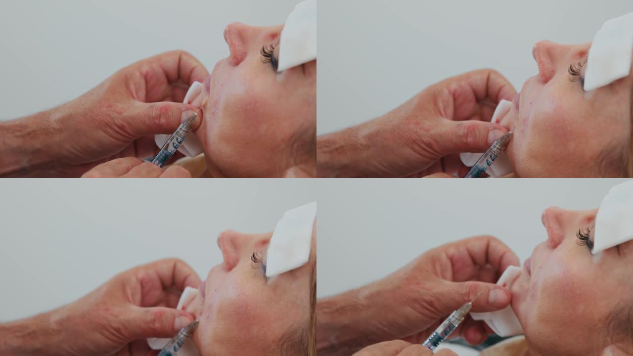 特写医生在美容医疗诊所用鼻唇沟中的透明质酸进行填充注射