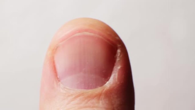 一个凌乱蓬乱的男人指甲的特写。指甲护理概念。