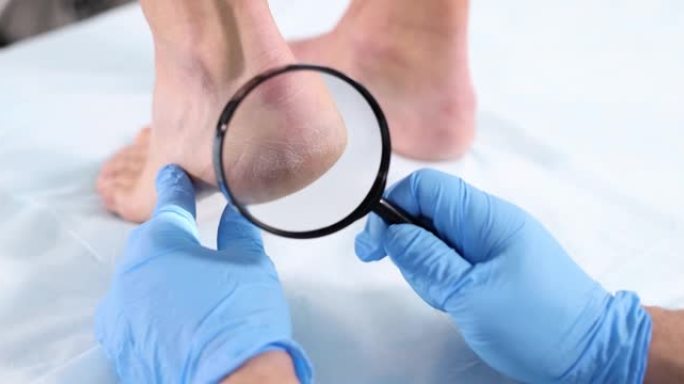 医生用放大镜特写4k电影慢动作检查女性患者脚后跟有裂纹的皮肤