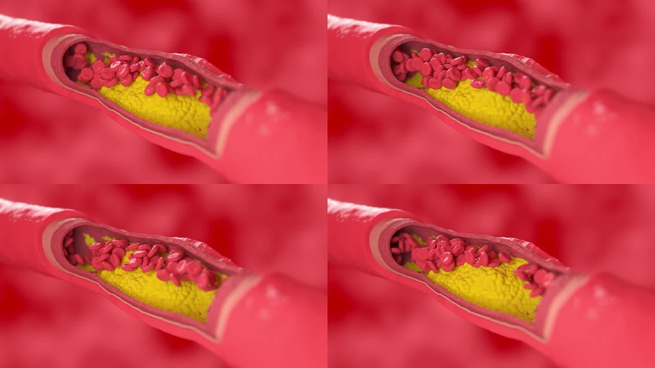 红细胞流经受胆固醇斑块影响的血管