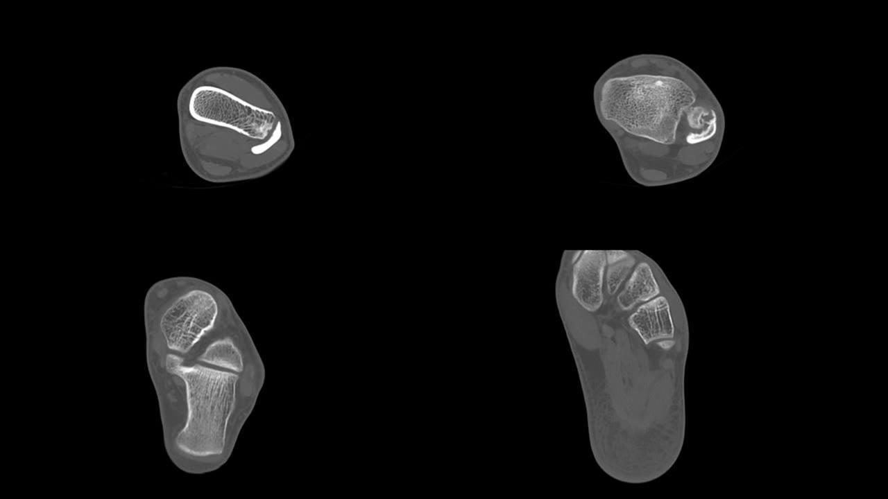 MRI足踝显示胫骨远端骨软骨瘤对腓骨造成压力效应。医学影像概念。
