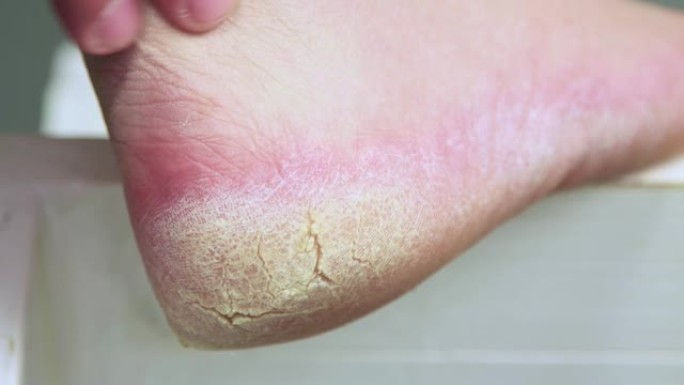 手指按摩腿上皮肤粗糙的龟裂后跟。