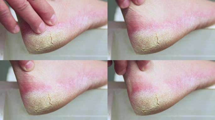 手指按摩腿上皮肤粗糙的龟裂后跟。