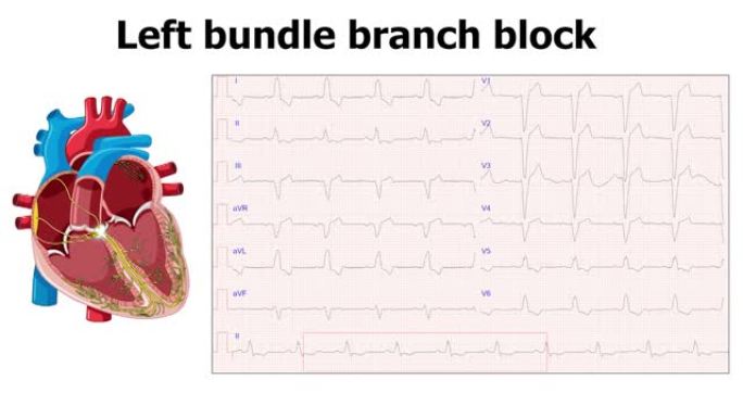心电图显示左束支传导阻滞 (LBBB) 与心脏动画
