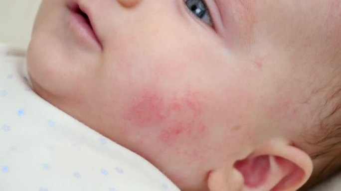 婴儿面部皮肤粉刺和皮炎痤疮的特写镜头。新生婴儿卫生、健康和皮肤护理的概念