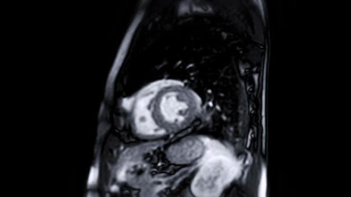 MRI心脏或心脏MRI (磁共振成像)。