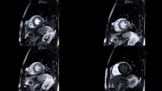 MRI心脏或心脏MRI (磁共振成像)。