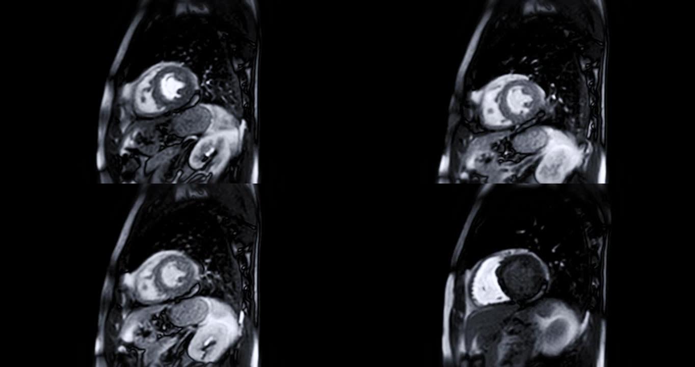 MRI心脏或心脏MRI (磁共振成像)。