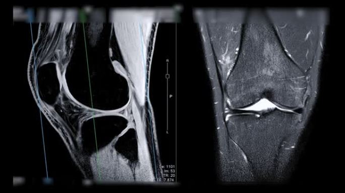 膝关节MRI或磁共振成像。