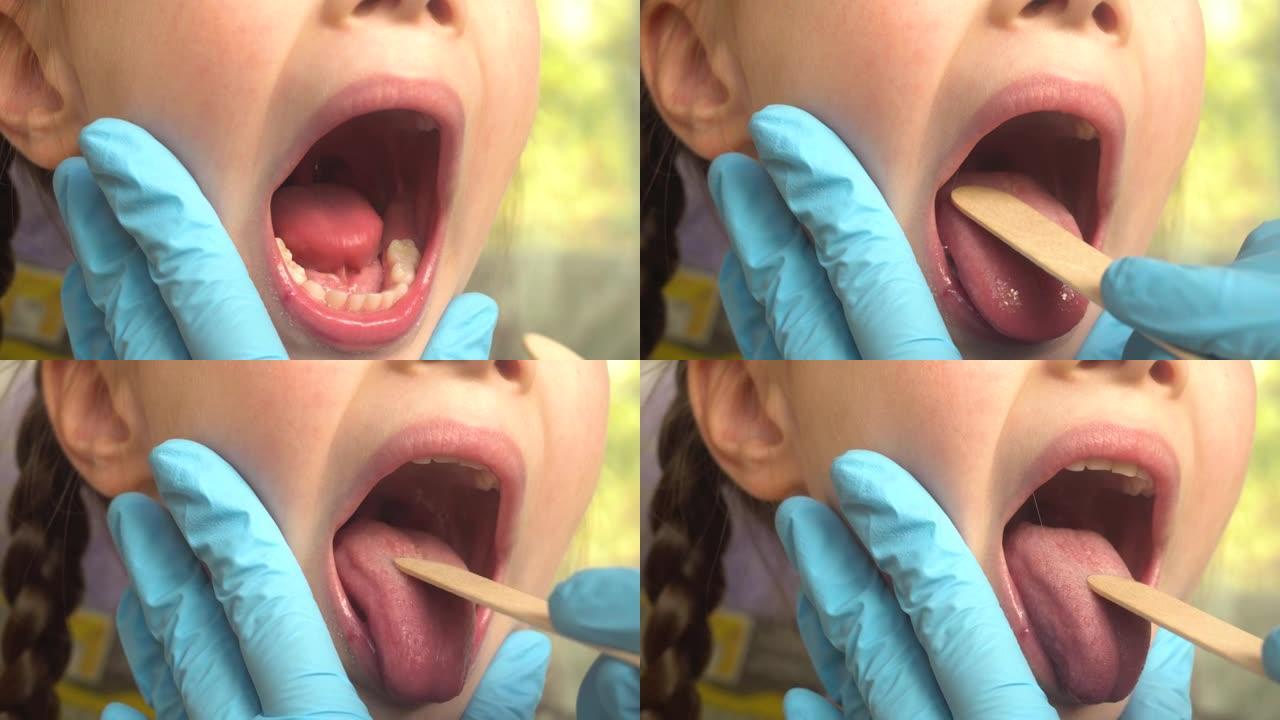 医生使用压舌板检查孩子的口腔和喉咙的特写镜头。耳鼻喉科药物。