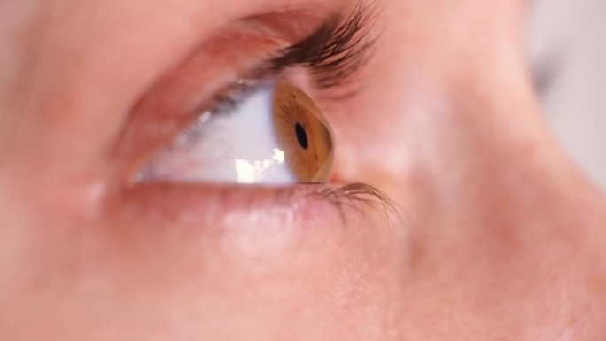 圆锥角膜患者的眼睛，圆锥角膜的形式，严重程度的疾病。