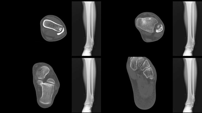 X线足踝显示胫骨远端骨软骨瘤对腓骨造成压力效应。医学影像概念。