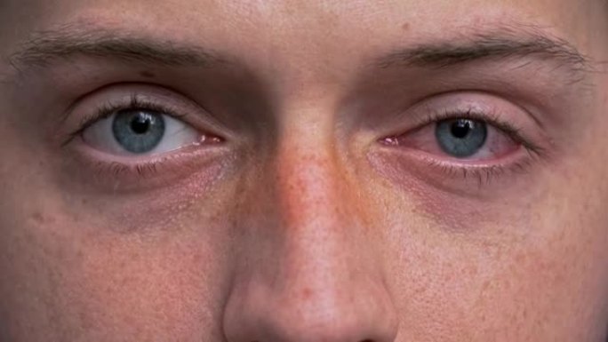 关闭两个恼怒的红血蓝眼睛的男性受结膜炎或后流感，感冒或过敏。健康、疾病和治疗的概念。复制广告空间。