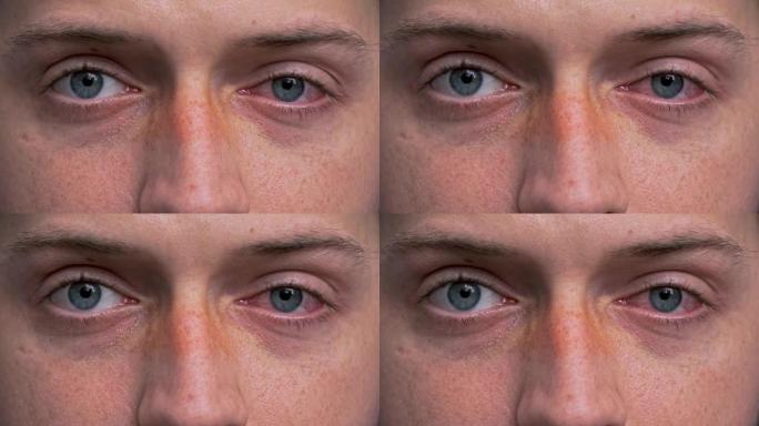 关闭两个恼怒的红血蓝眼睛的男性受结膜炎或后流感，感冒或过敏。健康、疾病和治疗的概念。复制广告空间。