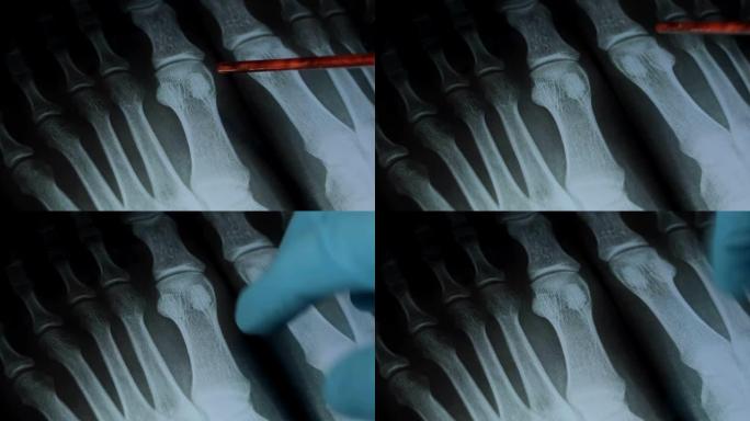关节炎。医生正在考虑做x光检查。在医学杂志上做记录。受影响的骨骼和关节。特写镜头。高清视频。