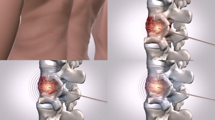 关节镜小针刀微创技术脊椎去除炎症恢复