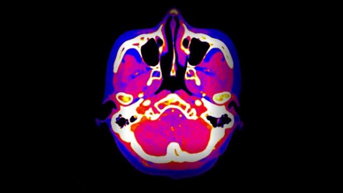 CTA脑或CT血管造影的脑轴视图融合粉红色。